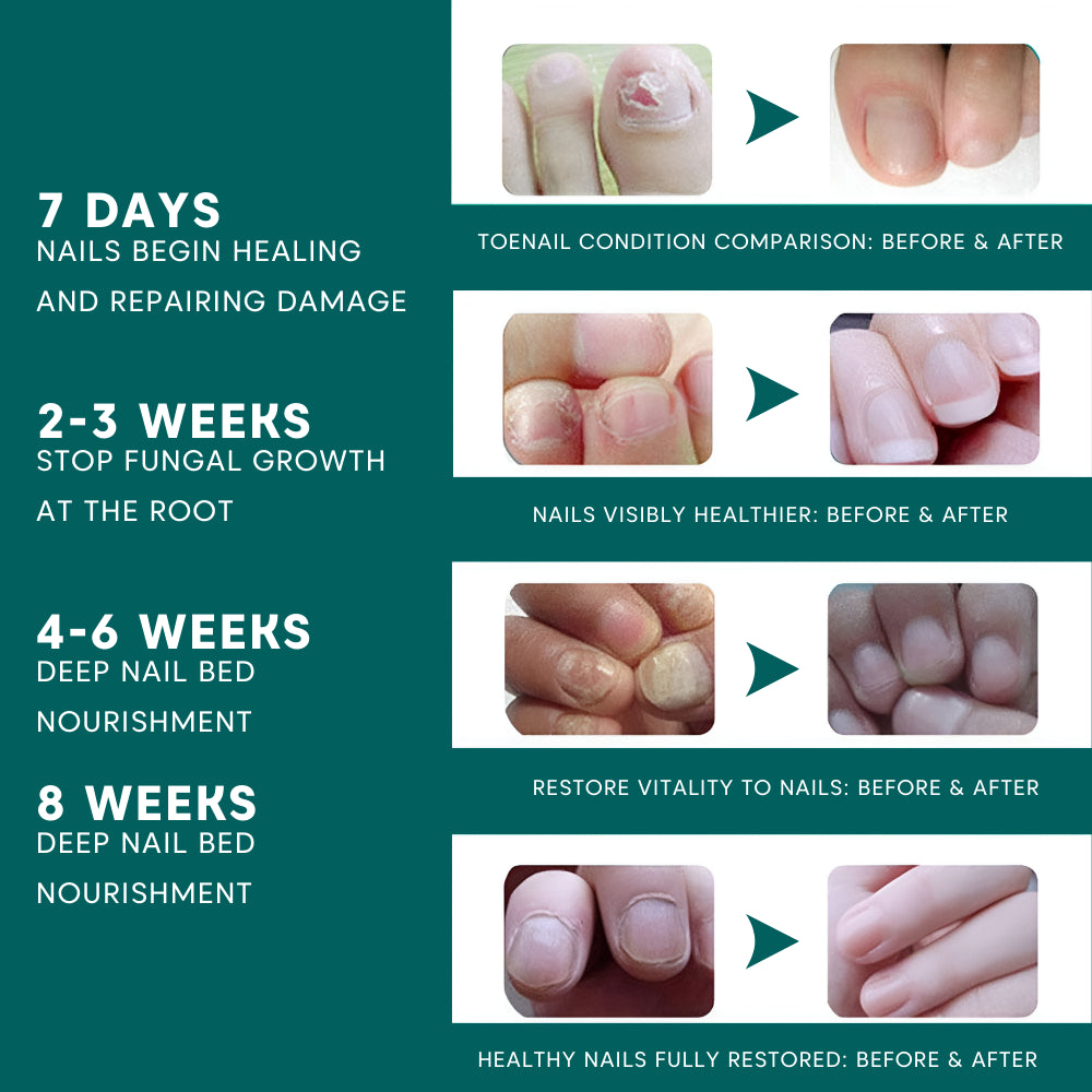Before and after images of nails with healing progress over 8 weeks on a green background