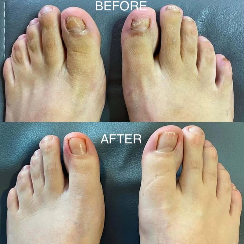 Nail Fungus Pen Acting Antifungal Treatment for Healthy Nails Before and after comparison of feet with a focus on toe health.