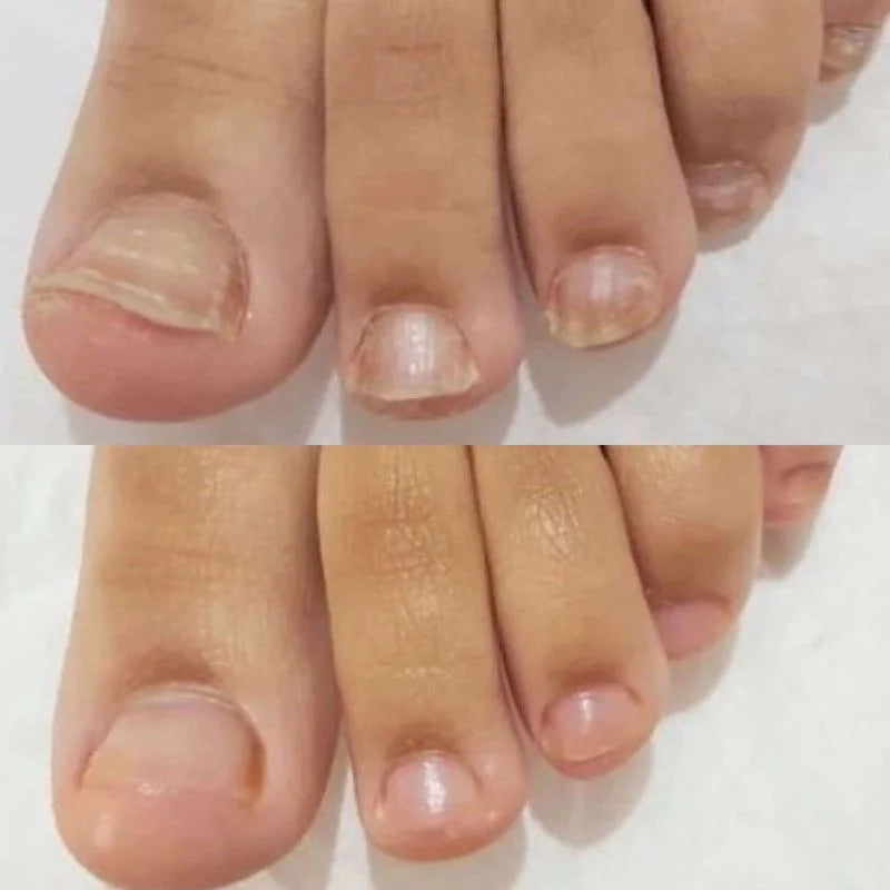 Close-up of two sets of toes with different nail conditions on a white background