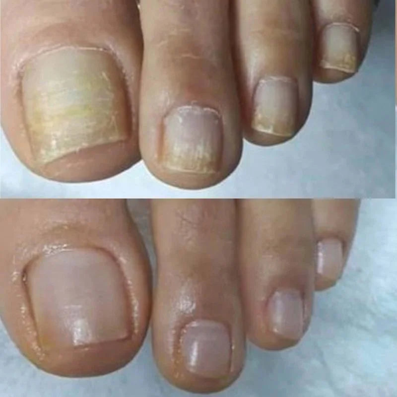 Close-up of toes with yellowish nail beds and clear nails.