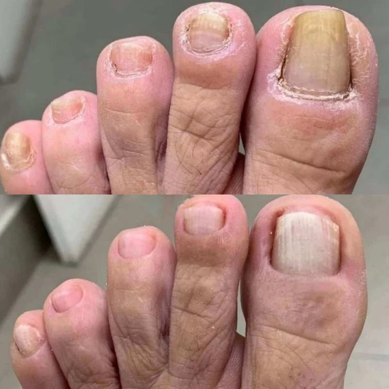 Before and after comparison of toenail health on a foot.
