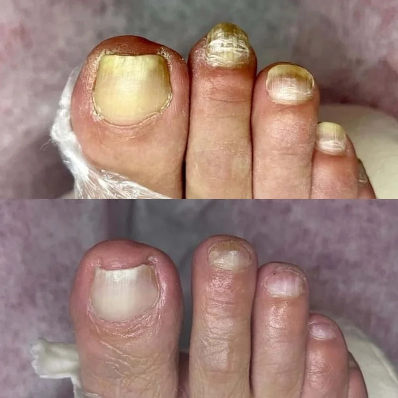 Before and after comparison of toenail health on a foot.